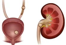 چگونه به خروج سنگ‌ کلیه سرعت بدهیم؟