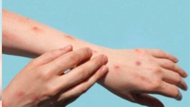 سرعت جهش ژنی «آبله میمونی ۱b»/ تفاوت این بیماری با کرونا